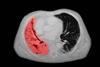 small cell lung cancer CT chest scan