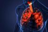 biologic-treatment-lung-condition