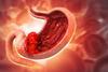 stomach cancer gastric concept