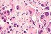 lung-cancer-adenocarcinoma-therapies