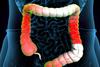 ulcerative-colitis-biologic
