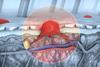 3d-illustration-crosssection-diseased-skin-melanoma