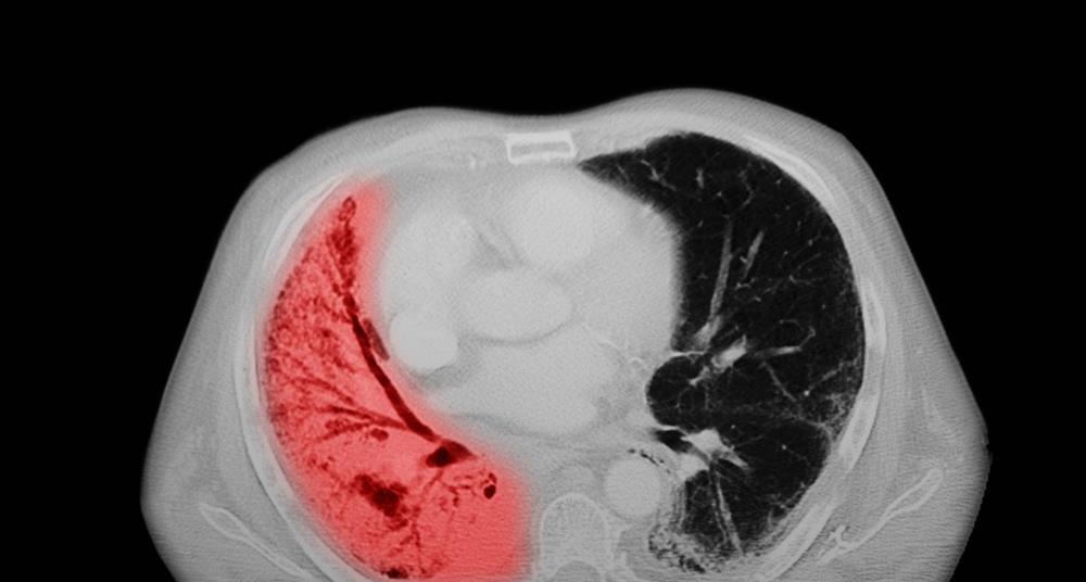 Amgen’s Imdylltra approved in Europe for aggressive solid tumour