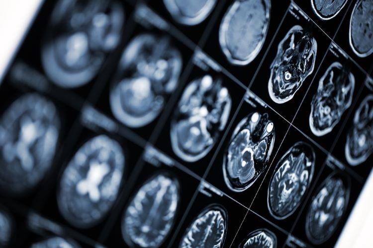 Roche multiple sclerosis subcutaneous injection: late-breaking data ...