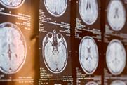 mri-human-brain-patient-multiple-sclerosis