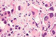 lung-cancer-adenocarcinoma-therapies