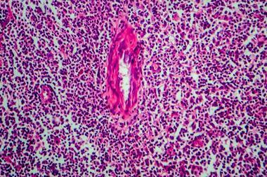 hodgkins lymphoma light micrograph image