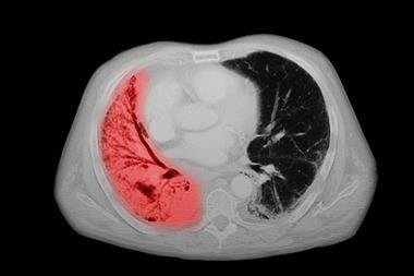 small cell lung cancer CT chest scan