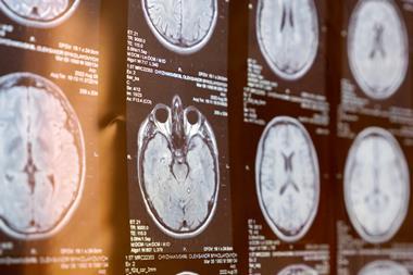 mri-human-brain-patient-multiple-sclerosis