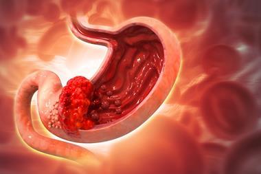 stomach cancer gastric concept
