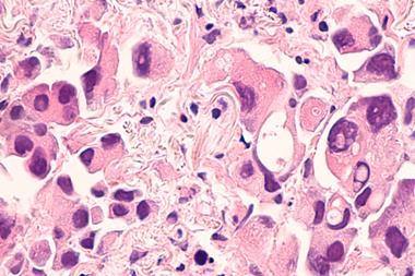lung-cancer-adenocarcinoma-therapies