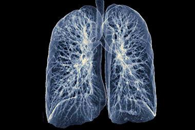 chest lung xray