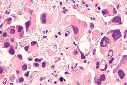 lung-cancer-adenocarcinoma-therapies