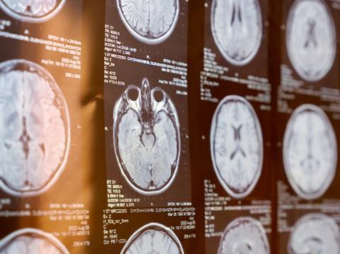 mri-human-brain-patient-multiple-sclerosis