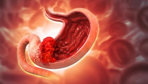 stomach cancer gastric concept