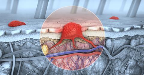 3d-illustration-crosssection-diseased-skin-melanoma