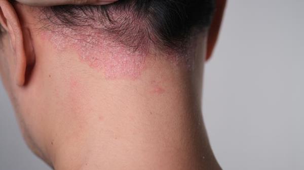 Tremfya Rash First-of-a-kind psoriasis study outcomes revealed | News | European ...